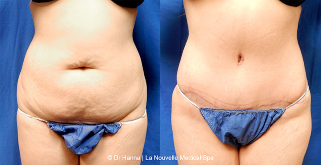 Tummy Tuck Ventura County, Abdominosplasty Before and After Photos by Dr. Hanna, La Nouvelle Medical Spa, Oxnard