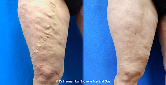 Varicose Vein Removal with Phlebectomy before after photos, Dr. Hanna La Nouvelle Medical Spa, Oxnard, Ventura County