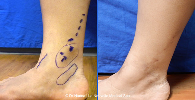 Varicose Vein Removal with Phlebectomy before after photos, Dr. Hanna La Nouvelle Medical Spa, Oxnard, Ventura County