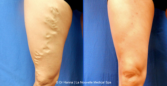 Varicose Vein Removal with Phlebectomy before after photos, Dr. Hanna La Nouvelle Medical Spa, Oxnard, Ventura County