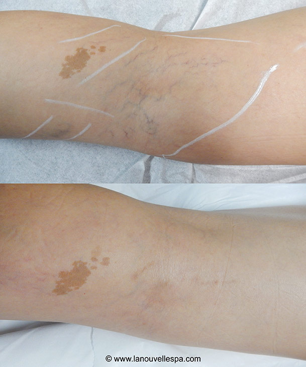 vein removal on ankle with asclera injections la nouvelle medical spa, oxnard, ventura