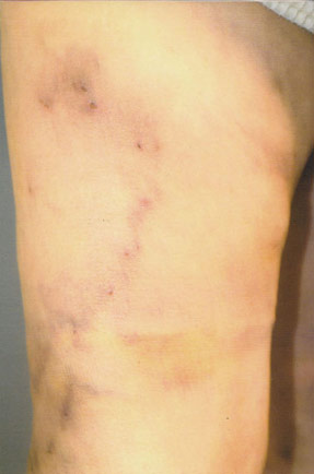 varicose phlebectomy vein removal ventura dr hanna