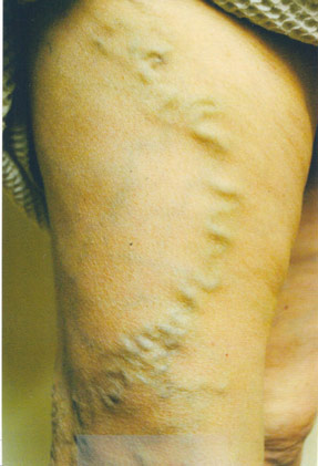 varicose vein removal phlebectomy ventura dr hanna