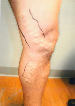 varicose laser vein removal ventura dr hanna