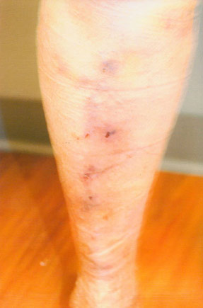 varicose laser vein removal ventura dr hanna