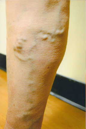 varicose laser vein removal ventura dr hanna