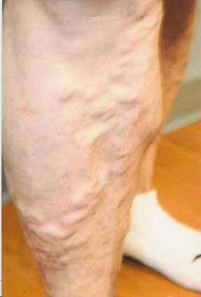 varicose laser vein removal ventura dr hanna