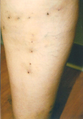 varicose laser vein removal ventura dr hanna