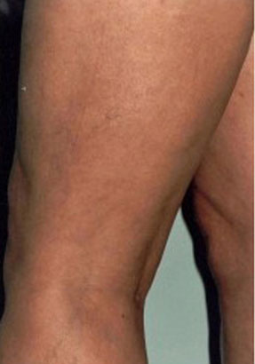 varicose laser vein removal ventura dr hanna