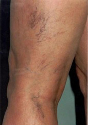 varicose laser vein removal ventura dr hanna