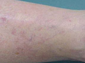 varicose laser vein removal ventura dr hanna