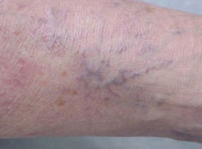 varicose laser vein removal ventura dr hanna