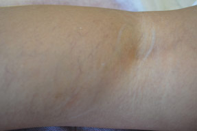 Varicose and Spider Vein Treatments - Before and After