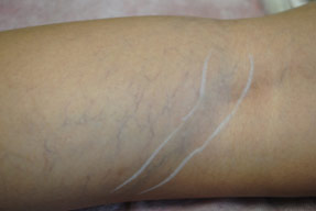 Varicose and Spider Vein Treatments - Before and After