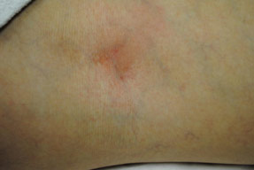 Varicose and Spider Vein Treatments - Before and After