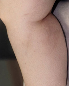 varicose laser vein removal ventura dr hanna