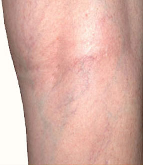 varicose laser vein removal ventura dr hanna