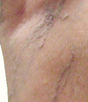 varicose laser vein removal ventura dr hanna