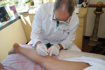 varicose vein treatment