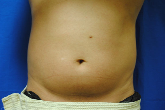 vaser shape on stomach before photo