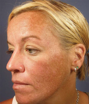 Vi peel sun damage before after la nouvelle medical spa
