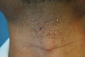 Wart removal before