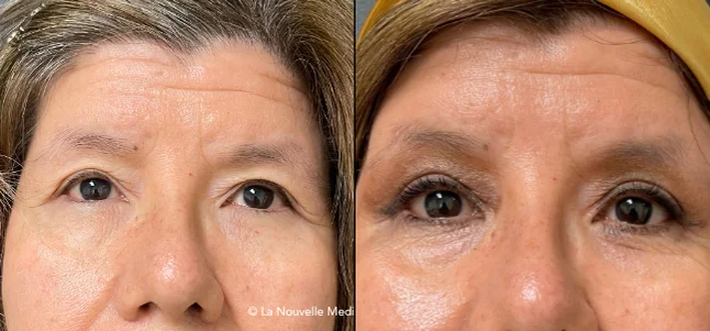Upper Blepharoplasty Eyelid Surgery before after photos Ventura, Thousand Oasks, La Nouvelle