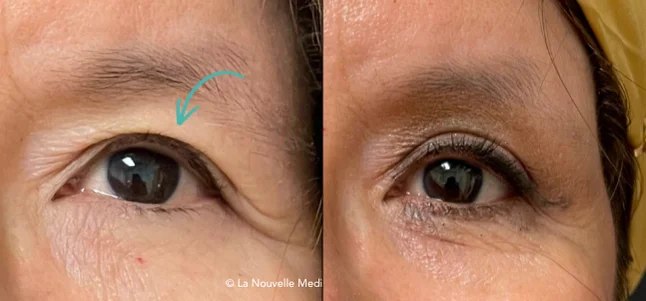 Upper Blepharoplasty Eyelid Surgery before after photos Ventura, Thousand Oasks, La Nouvelle