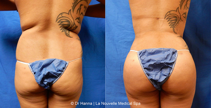 Brazilian Butt Lift Before and After Photos