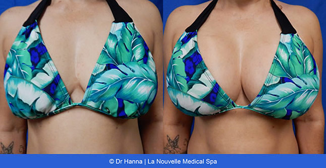 🥇 West Palm Beach Best Breast Augmentation, Implants