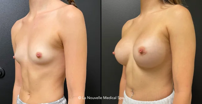 breast augmentation with silicone implants before & after photos, Ventura County, Los Angeles, Thousand Oaks
