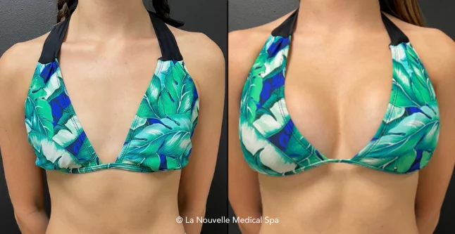 breast augmentation with silicone implants before & after photos, Ventura County, Los Angeles, Thousand Oaks