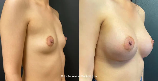 breast augmentation with silicone implants before & after photos, Ventura County, Los Angeles, Thousand Oaks