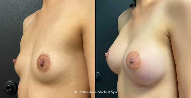 breast augmentation with silicone implants before & after photos, Ventura County, Los Angeles, Thousand Oaks