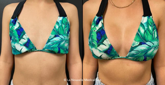 breast augmentation with silicone implants before & after photos, Ventura County, Los Angeles, Thousand Oaks