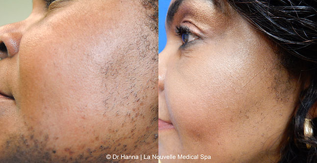 laser hair removal before and after face