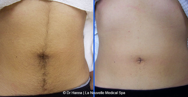 laser hair removal before and after women