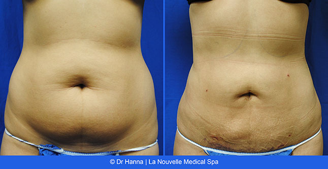 Before And After Photos Of Laser Liposuction Smartlipo Vaser Lipo.