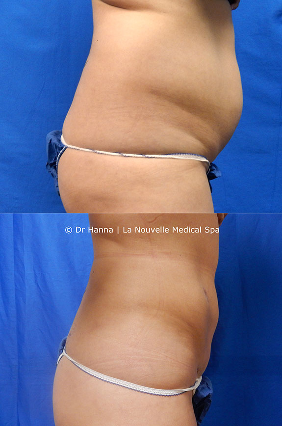 Tumescent Liposuction under local anesthesia - Ventura County