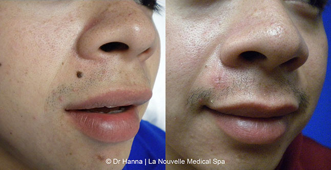 Leison and mole removal before after photos by dr. Hanna, La Nouvelle Medical Spa, Oxnard, Ventura County 