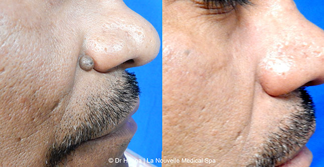 Leison and mole removal before after photos by dr. Hanna, La Nouvelle Medical Spa, Oxnard, Ventura County 