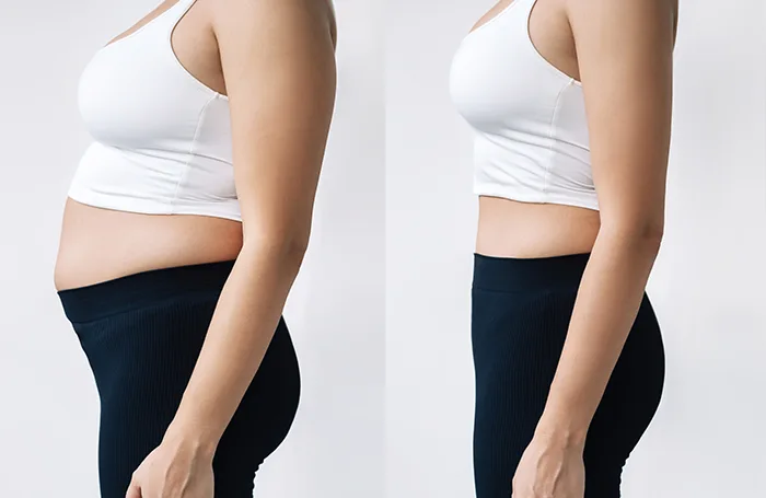tummy tuck abdominoplasty before after surgery Ventura County and Los Angeles