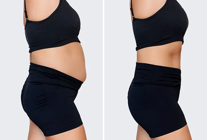 tummy tuck abdominoplasty before after surgery Ventura County and Los Angeles2