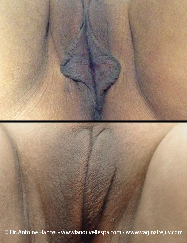 Labiaplasty,Vaginoplasty, Vaginal Rejuvenation by dr. Hanna, La Nouvelle Medical Center, Ventura County
